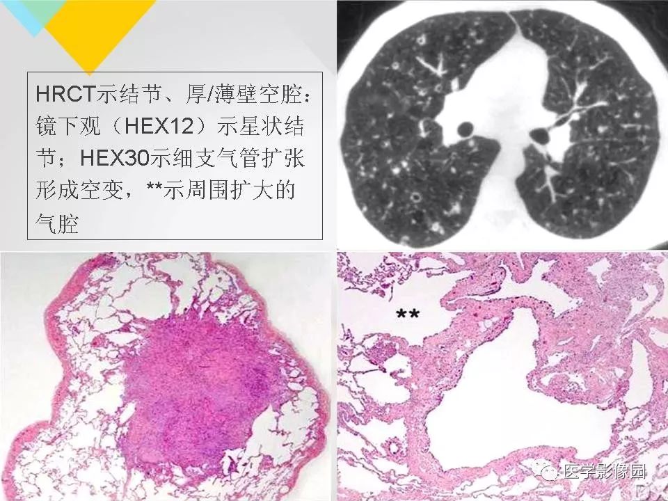 影像PPT - 【PPT】吸烟相关性间质性肺疾病的HRCT诊断-69
