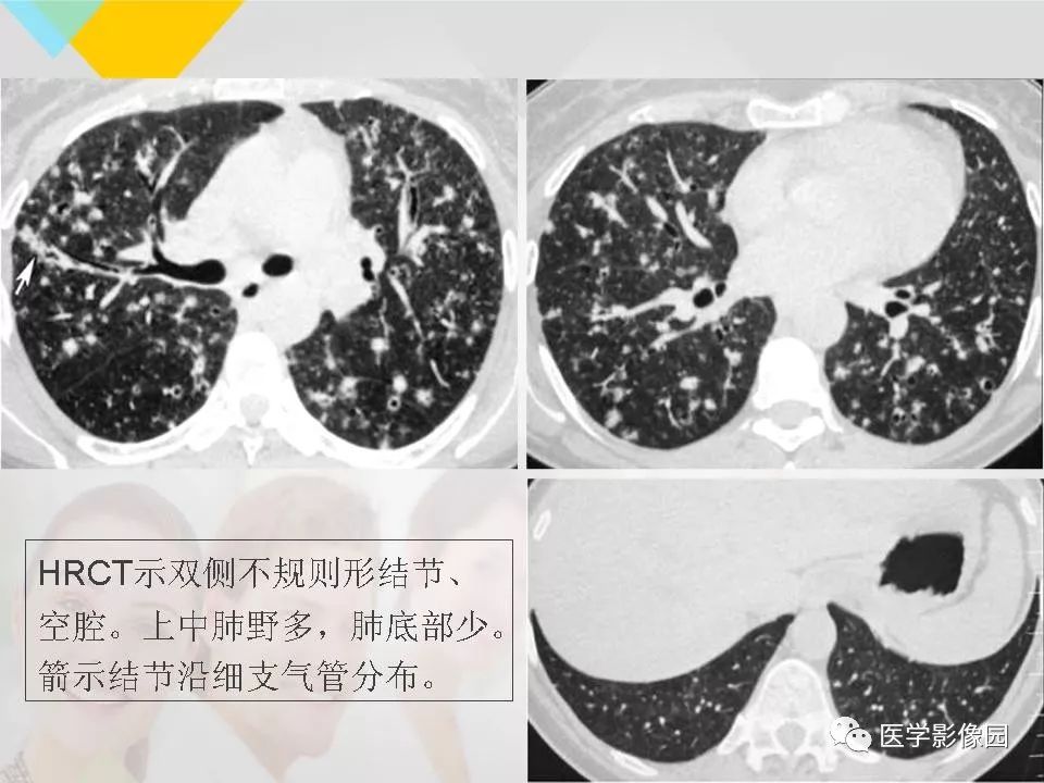 影像PPT - 【PPT】吸烟相关性间质性肺疾病的HRCT诊断-73