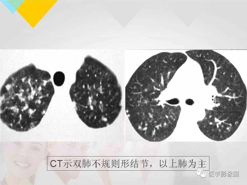 影像PPT - 【PPT】吸烟相关性间质性肺疾病的HRCT诊断-72