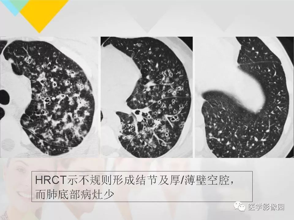 影像PPT - 【PPT】吸烟相关性间质性肺疾病的HRCT诊断-74
