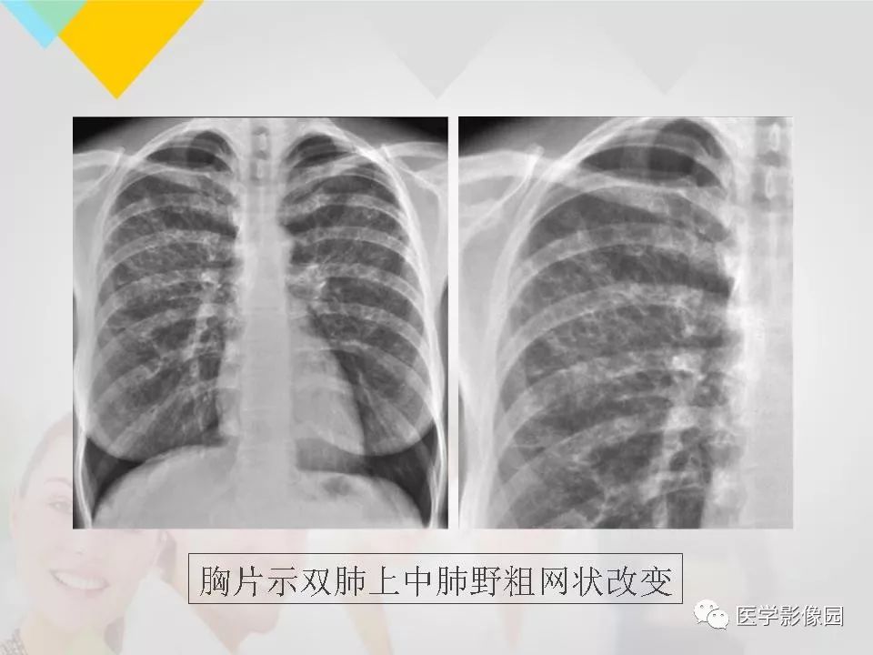 影像PPT - 【PPT】吸烟相关性间质性肺疾病的HRCT诊断-67