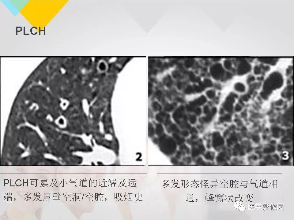 影像PPT - 【PPT】吸烟相关性间质性肺疾病的HRCT诊断-76