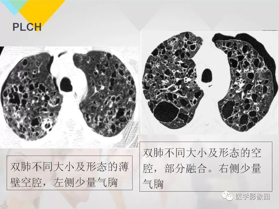 影像PPT - 【PPT】吸烟相关性间质性肺疾病的HRCT诊断-77