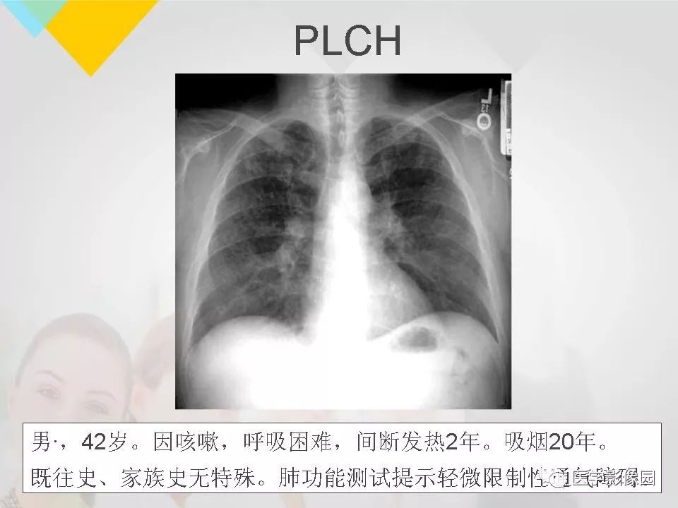 影像PPT - 【PPT】吸烟相关性间质性肺疾病的HRCT诊断-82