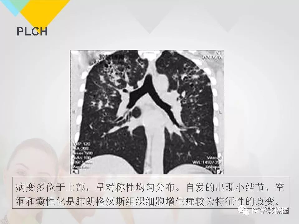 影像PPT - 【PPT】吸烟相关性间质性肺疾病的HRCT诊断-86