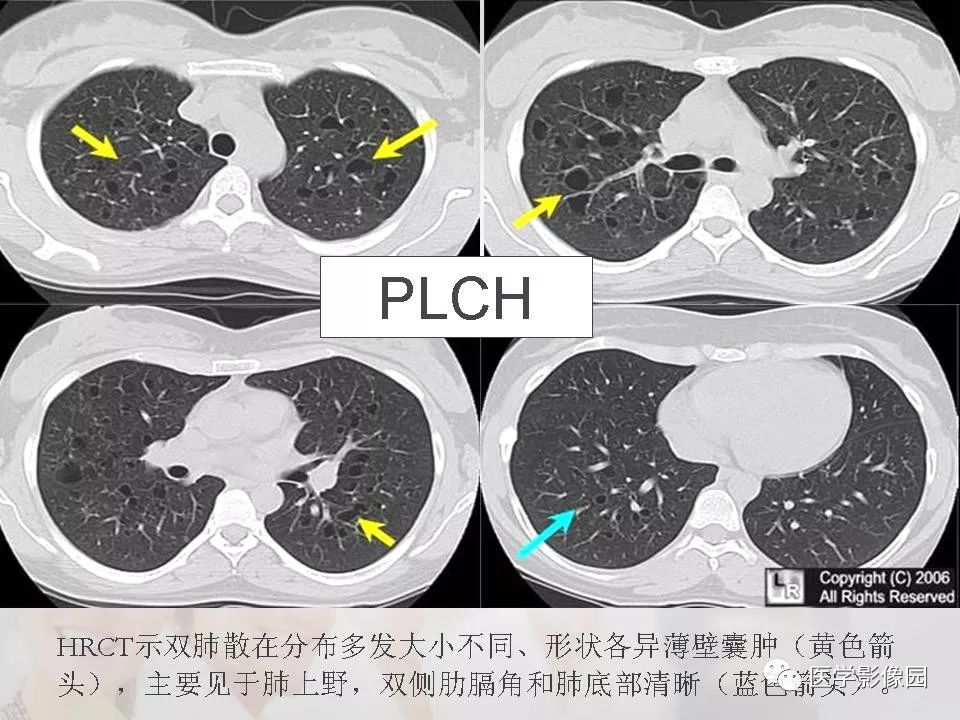 影像PPT - 【PPT】吸烟相关性间质性肺疾病的HRCT诊断-84