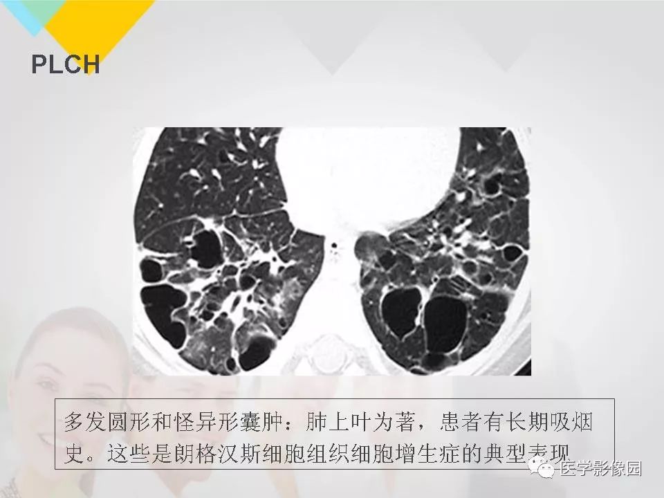 影像PPT - 【PPT】吸烟相关性间质性肺疾病的HRCT诊断-89
