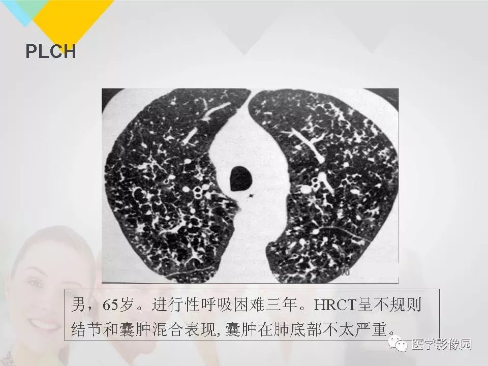 影像PPT - 【PPT】吸烟相关性间质性肺疾病的HRCT诊断-87