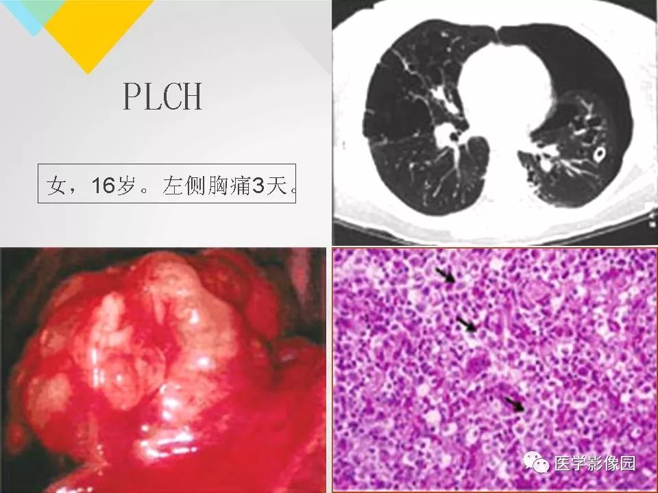 影像PPT - 【PPT】吸烟相关性间质性肺疾病的HRCT诊断-85