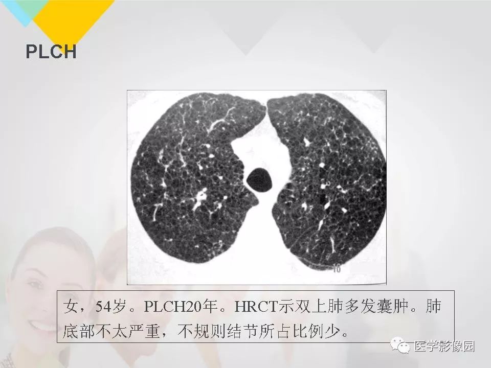 影像PPT - 【PPT】吸烟相关性间质性肺疾病的HRCT诊断-88