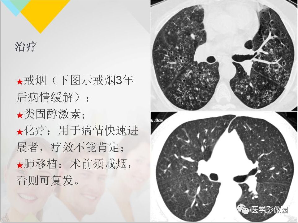 影像PPT - 【PPT】吸烟相关性间质性肺疾病的HRCT诊断-91