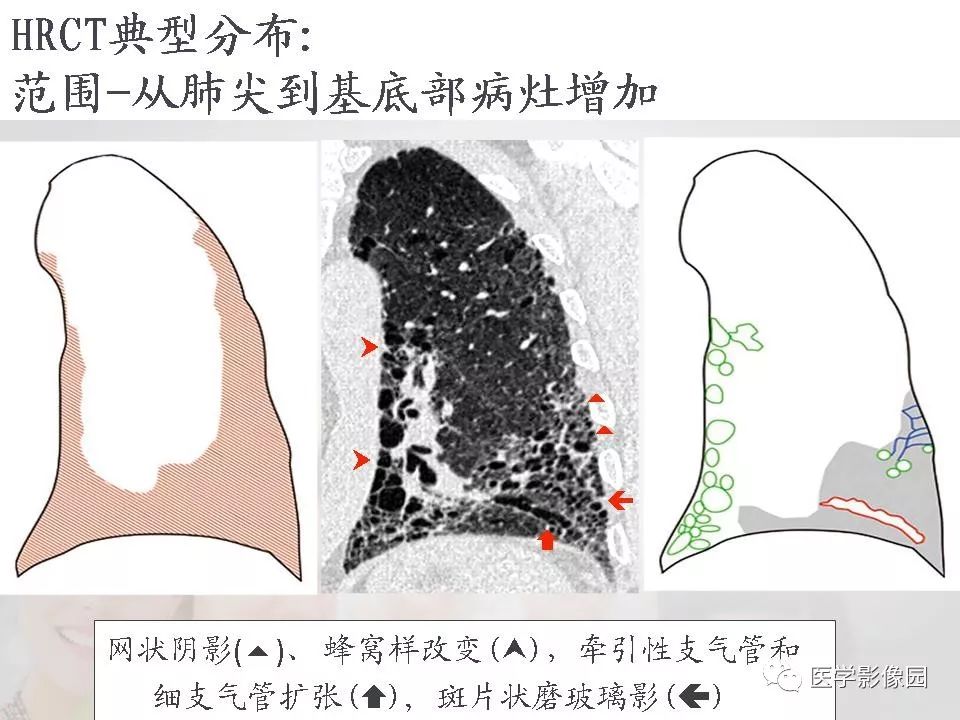 影像PPT - 【PPT】吸烟相关性间质性肺疾病的HRCT诊断-106