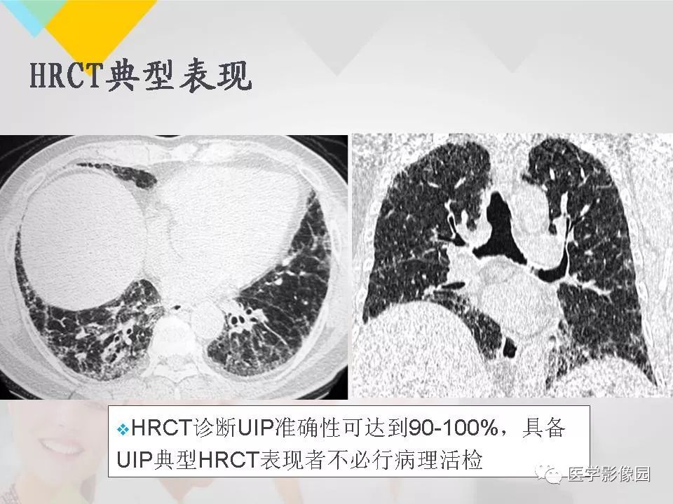 影像PPT - 【PPT】吸烟相关性间质性肺疾病的HRCT诊断-108