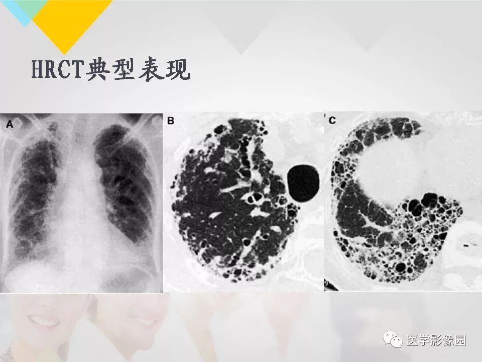 影像PPT - 【PPT】吸烟相关性间质性肺疾病的HRCT诊断-109
