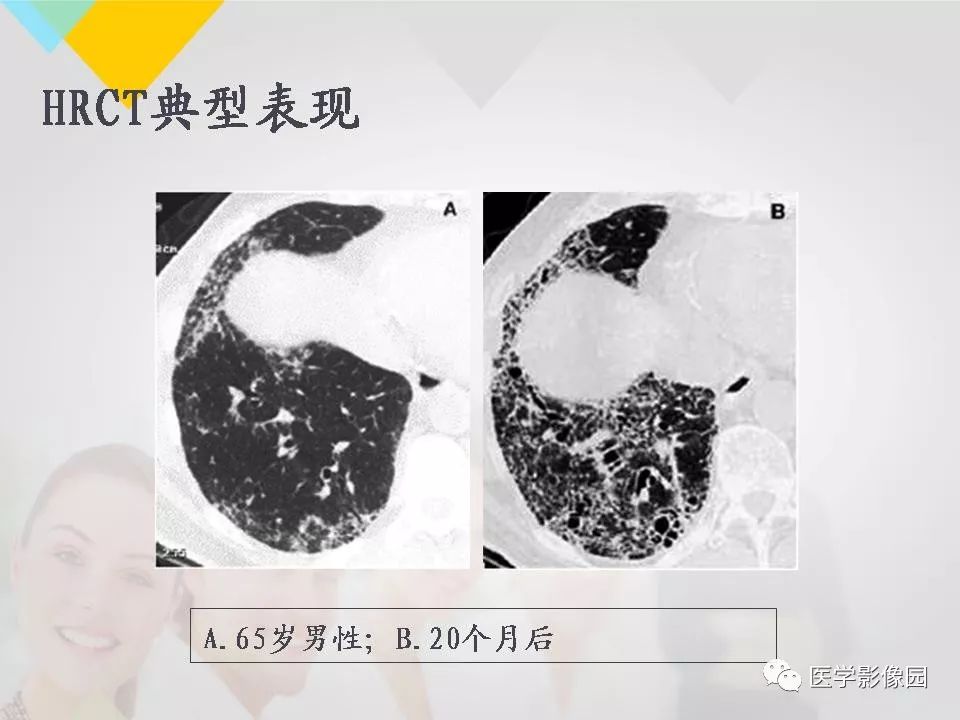 影像PPT - 【PPT】吸烟相关性间质性肺疾病的HRCT诊断-110