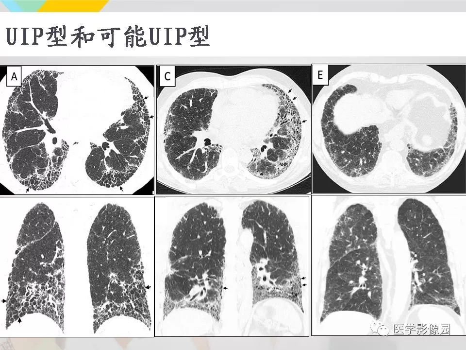 影像PPT - 【PPT】吸烟相关性间质性肺疾病的HRCT诊断-105