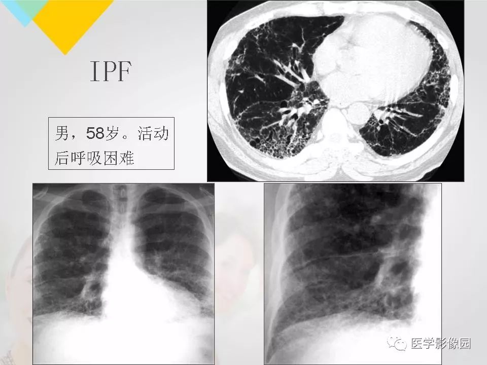 影像PPT - 【PPT】吸烟相关性间质性肺疾病的HRCT诊断-112