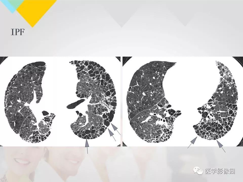 影像PPT - 【PPT】吸烟相关性间质性肺疾病的HRCT诊断-113