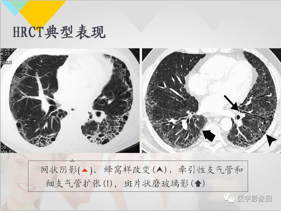 影像PPT - 【PPT】吸烟相关性间质性肺疾病的HRCT诊断-107
