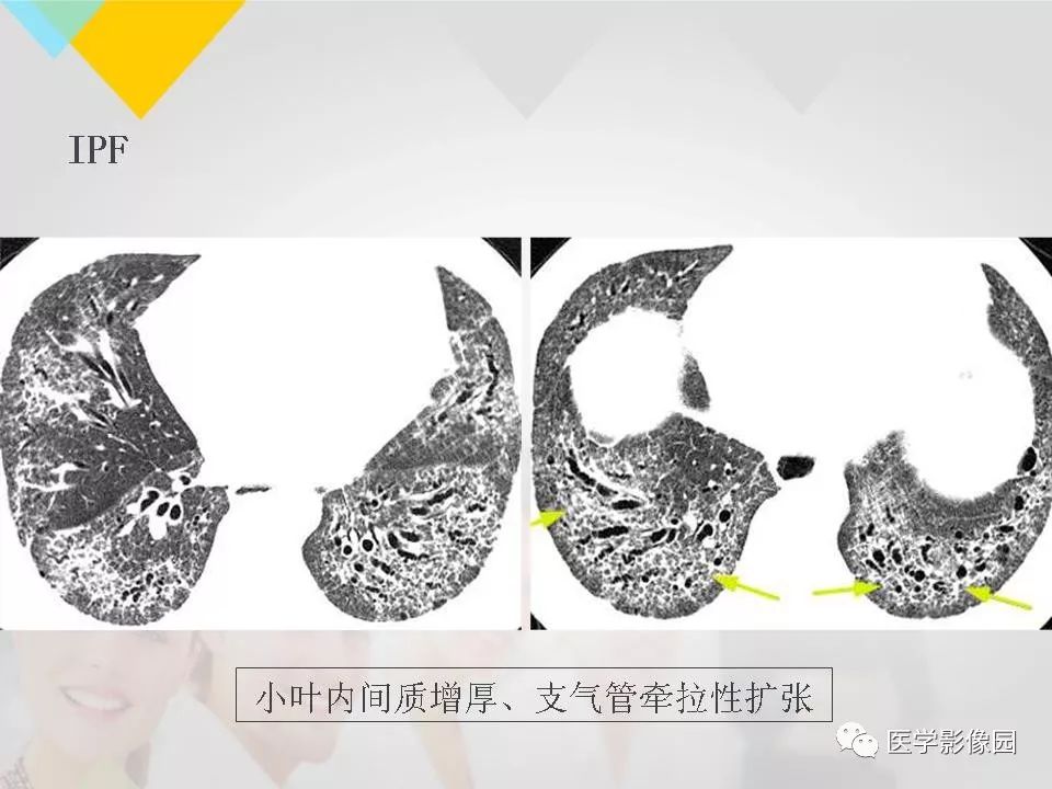 影像PPT - 【PPT】吸烟相关性间质性肺疾病的HRCT诊断-117