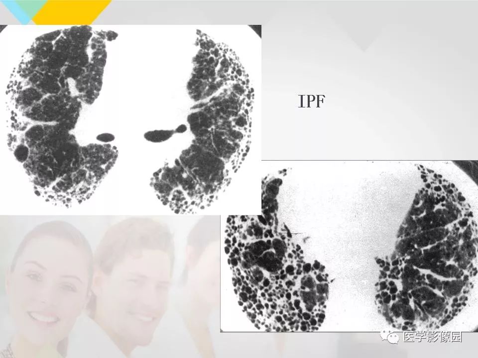 影像PPT - 【PPT】吸烟相关性间质性肺疾病的HRCT诊断-114