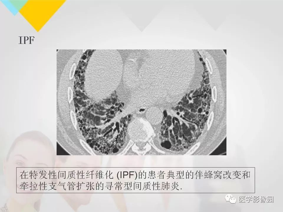 影像PPT - 【PPT】吸烟相关性间质性肺疾病的HRCT诊断-119