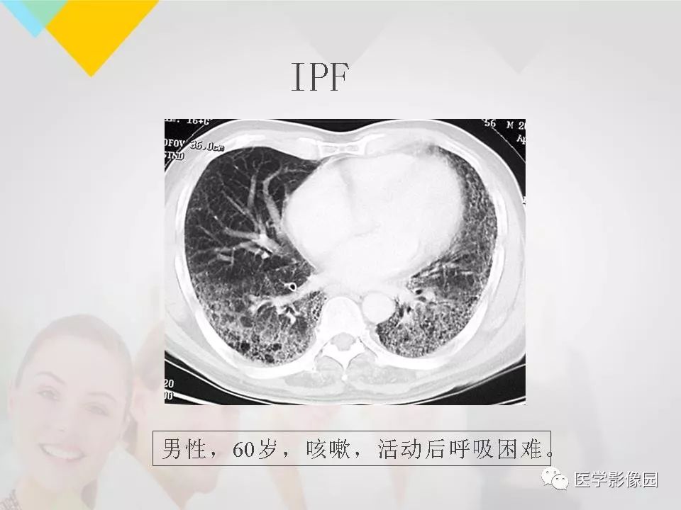 影像PPT - 【PPT】吸烟相关性间质性肺疾病的HRCT诊断-115
