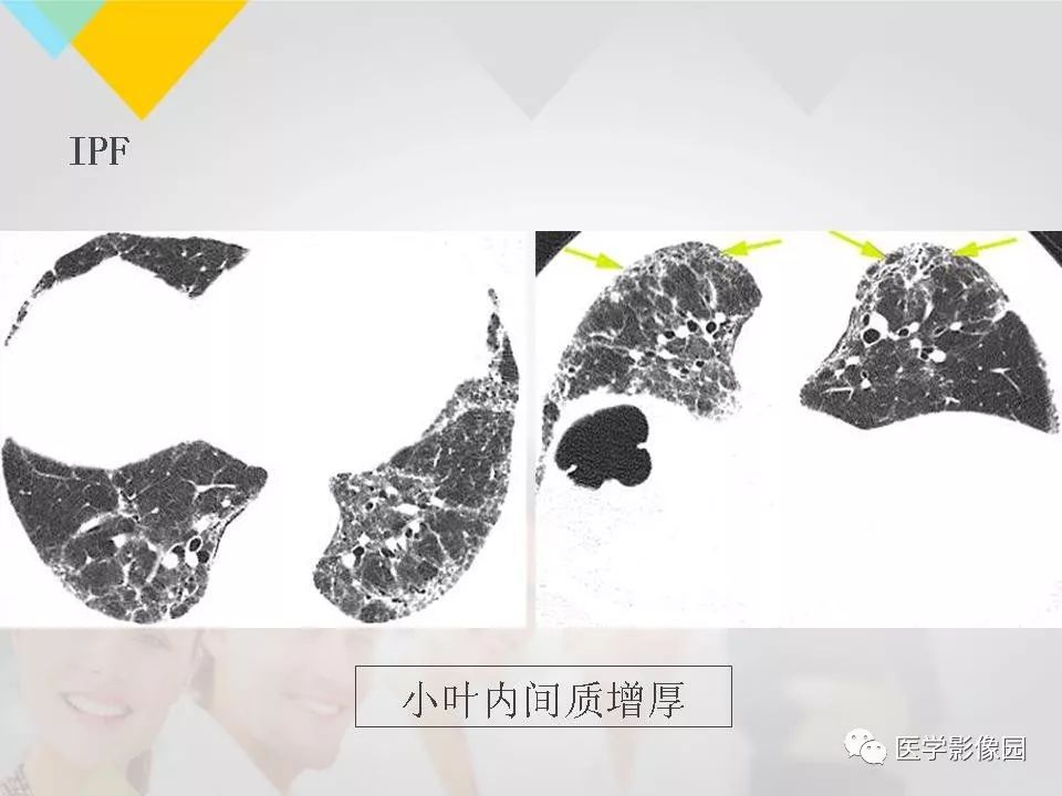 影像PPT - 【PPT】吸烟相关性间质性肺疾病的HRCT诊断-118