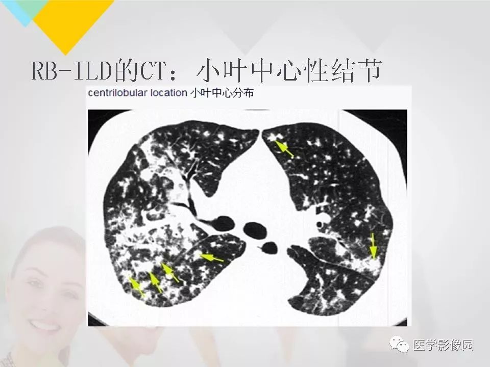 影像PPT - 【PPT】吸烟相关性间质性肺疾病的HRCT诊断-1