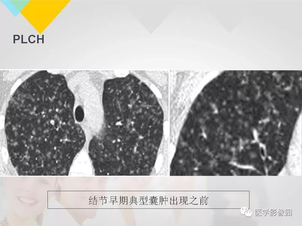 影像PPT - 【PPT】吸烟相关性间质性肺疾病的HRCT诊断-2