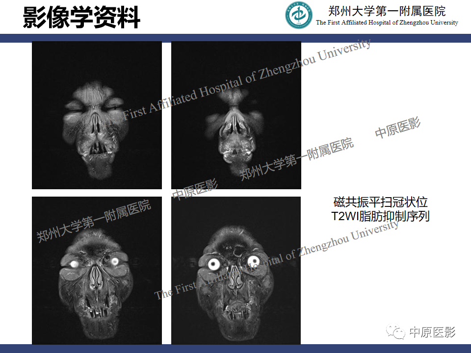 影像PPT - 【病例】眼眶周围淋巴瘤1例CT及MR-6