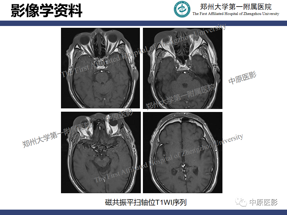 影像PPT - 【病例】眼眶周围淋巴瘤1例CT及MR-3