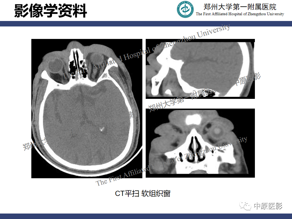 影像PPT - 【病例】眼眶周围淋巴瘤1例CT及MR-7