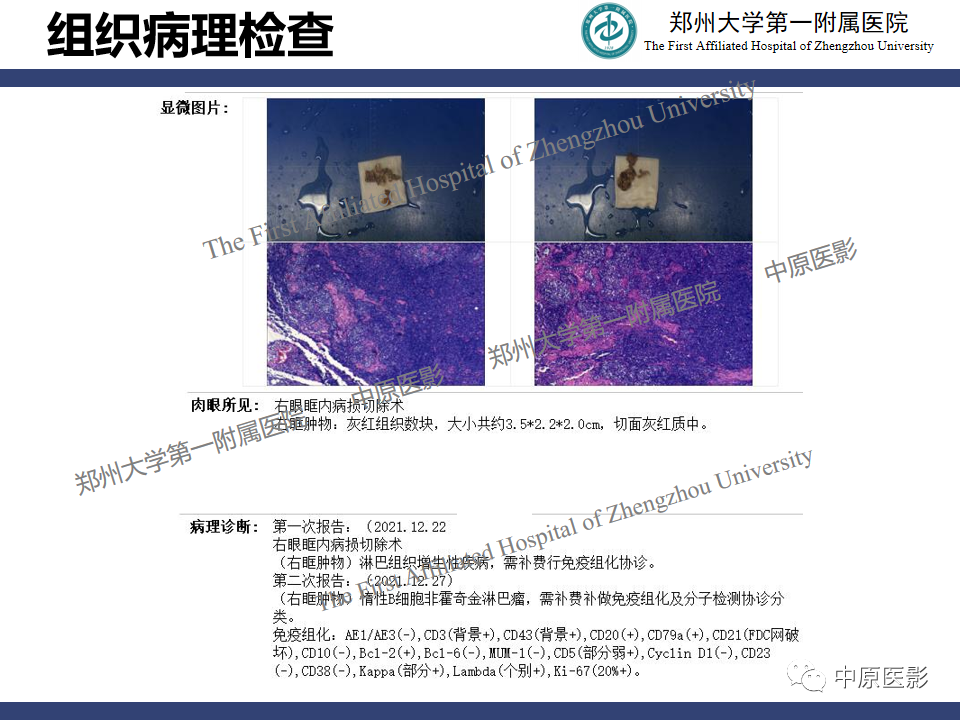 影像PPT - 【病例】眼眶周围淋巴瘤1例CT及MR-10