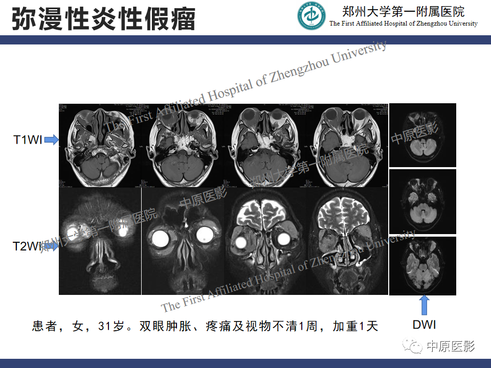 影像PPT - 【病例】眼眶周围淋巴瘤1例CT及MR-22
