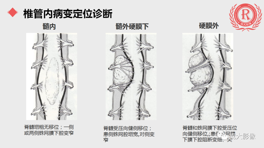 影像PPT - 【PPT】脊膜瘤影像表现-4