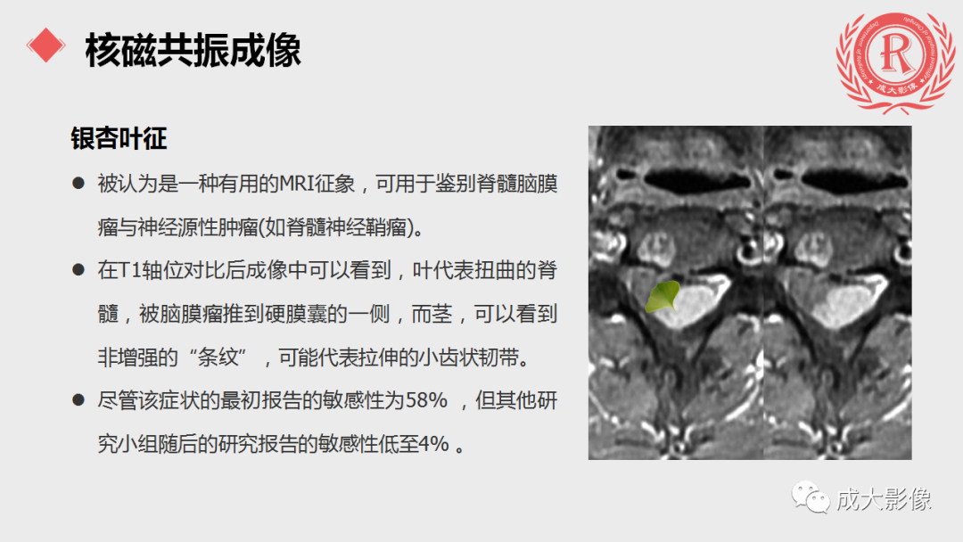 影像PPT - 【PPT】脊膜瘤影像表现-11