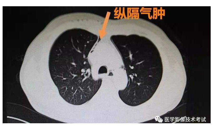 影像PPT - “动脉周围环形征”的影像诊断意义-2