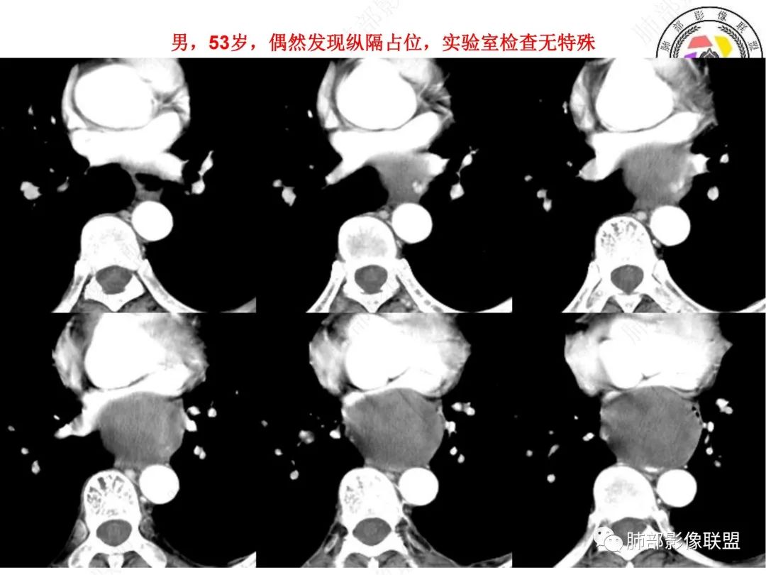 影像PPT - 【病例】后纵隔囊实性占位-2 影像PPT - 【病例】后纵隔囊实性占位-2