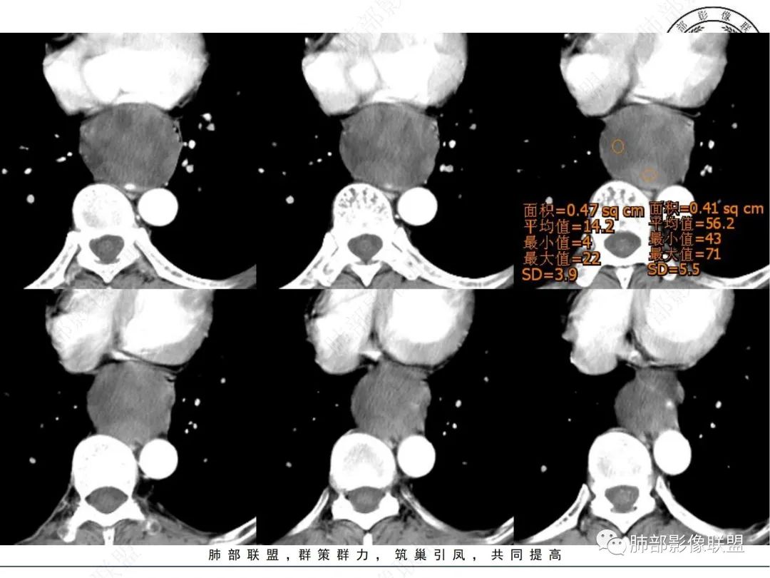 影像PPT - 【病例】后纵隔囊实性占位-3 影像PPT - 【病例】后纵隔囊实性占位-3