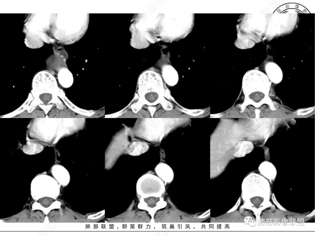 影像PPT - 【病例】后纵隔囊实性占位-4 影像PPT - 【病例】后纵隔囊实性占位-4