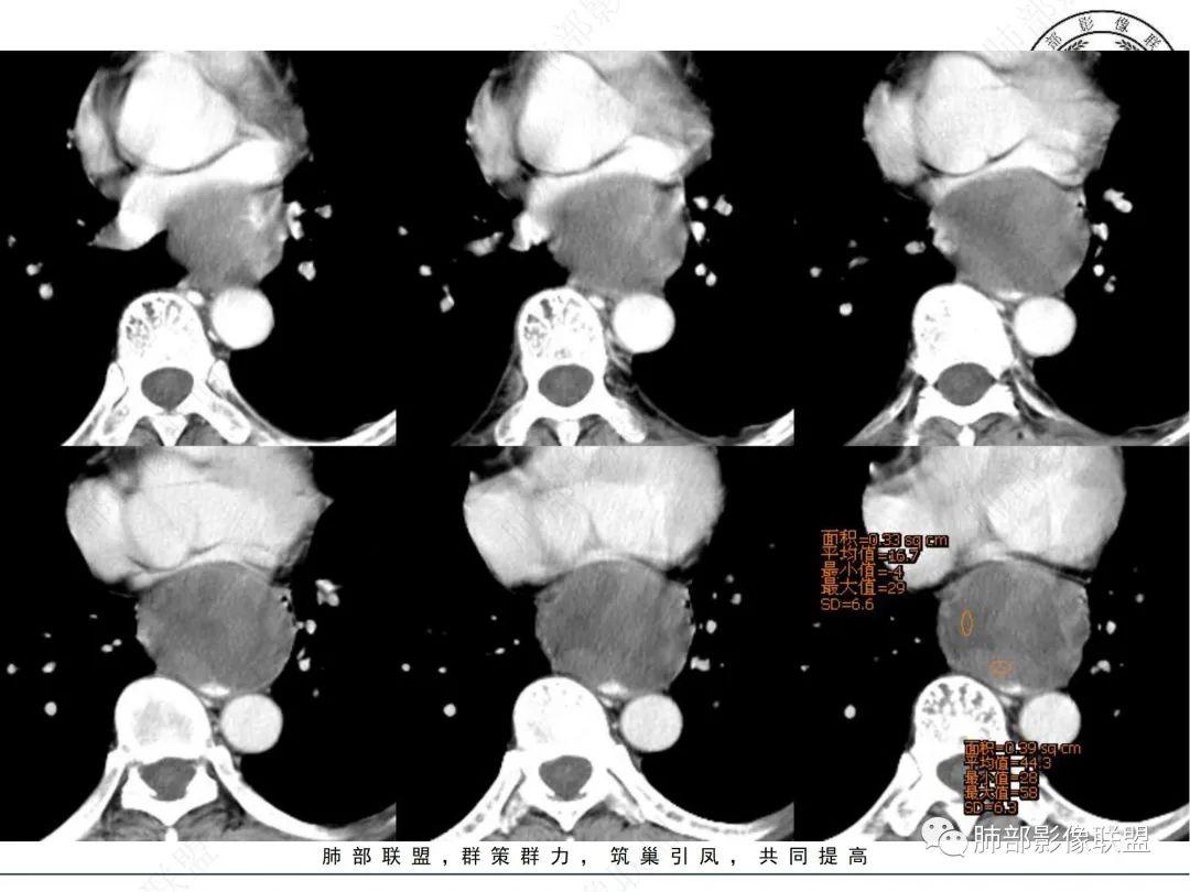 影像PPT - 【病例】后纵隔囊实性占位-5 影像PPT - 【病例】后纵隔囊实性占位-5