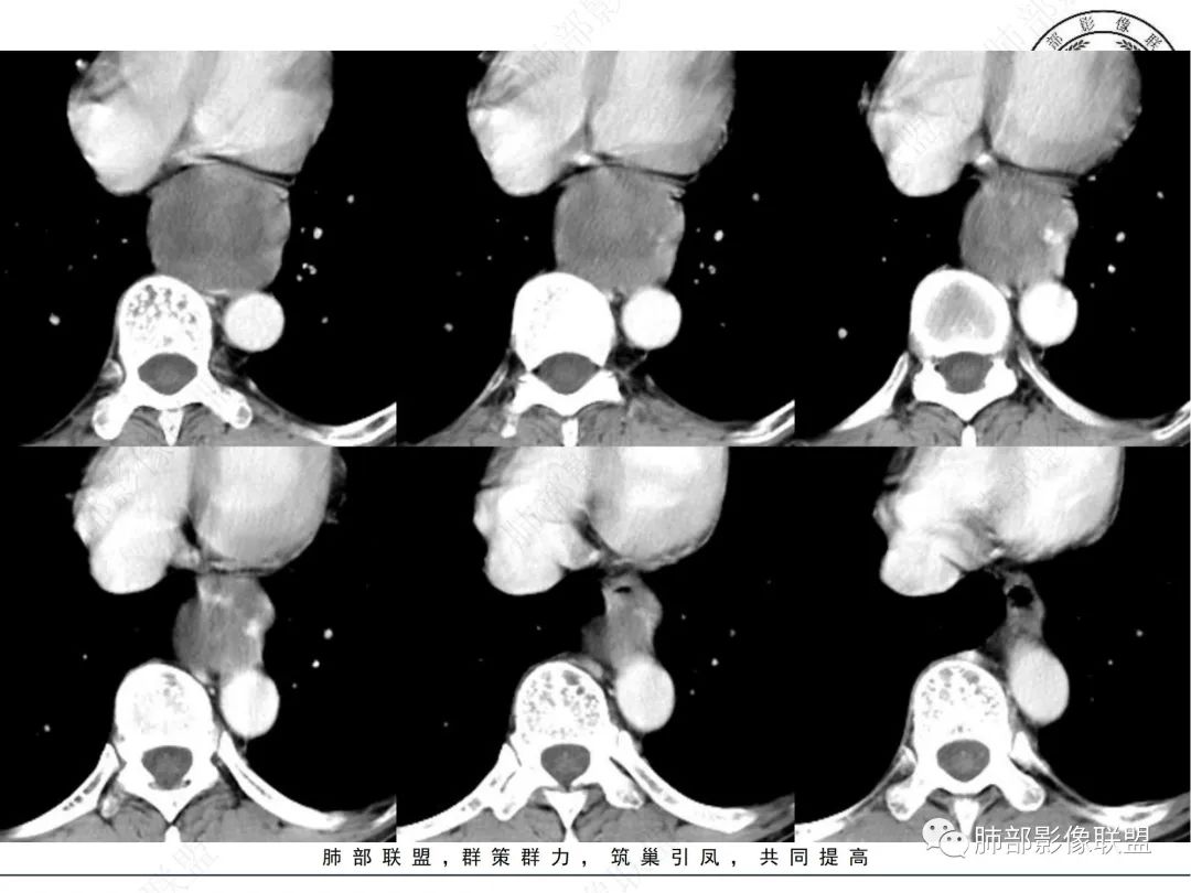 影像PPT - 【病例】后纵隔囊实性占位-6 影像PPT - 【病例】后纵隔囊实性占位-6