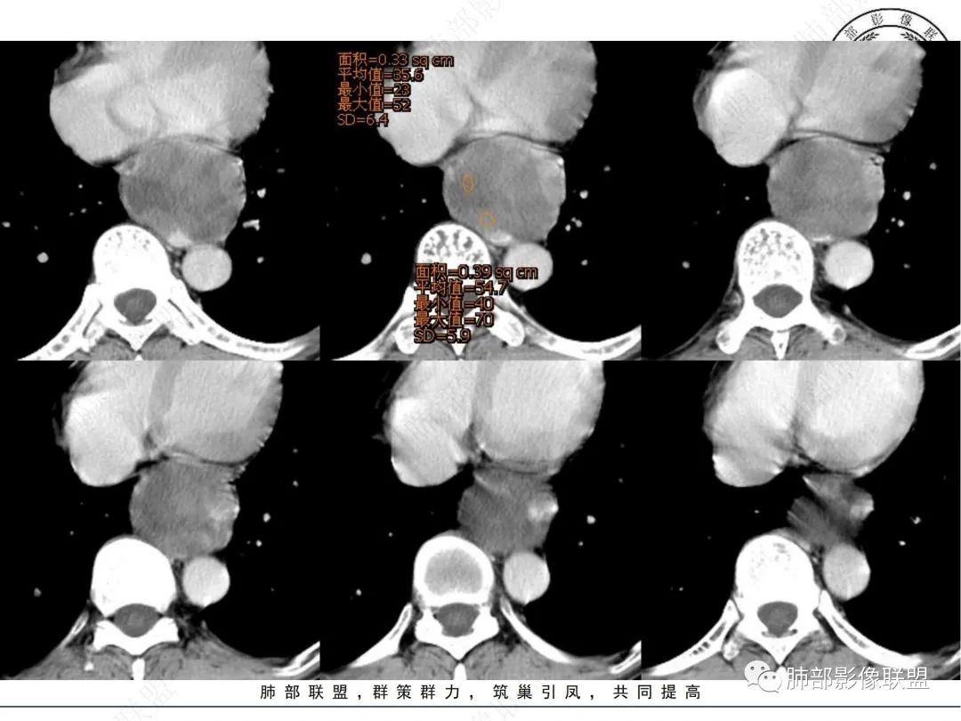 影像PPT - 【病例】后纵隔囊实性占位-8 影像PPT - 【病例】后纵隔囊实性占位-8
