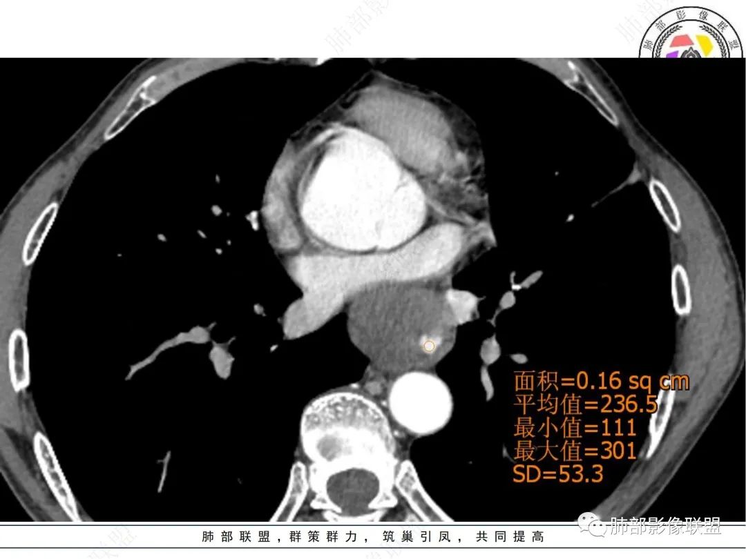 影像PPT - 【病例】后纵隔囊实性占位-9 影像PPT - 【病例】后纵隔囊实性占位-9