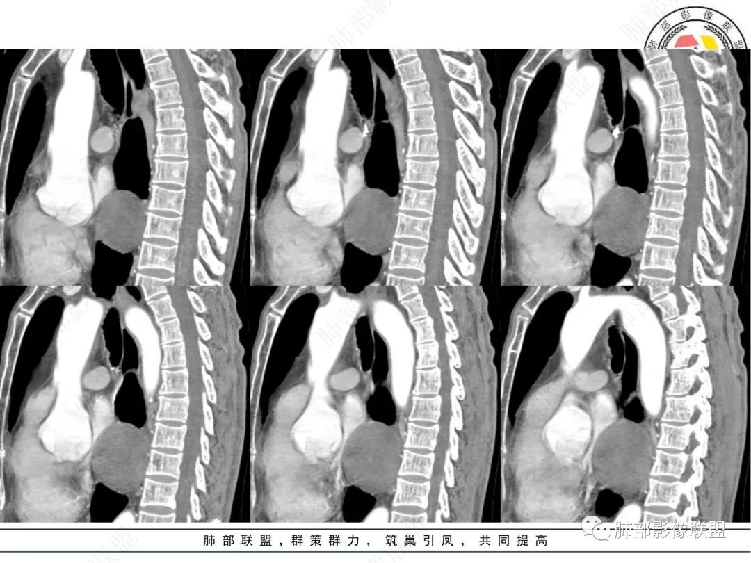 影像PPT - 【病例】后纵隔囊实性占位-10 影像PPT - 【病例】后纵隔囊实性占位-10