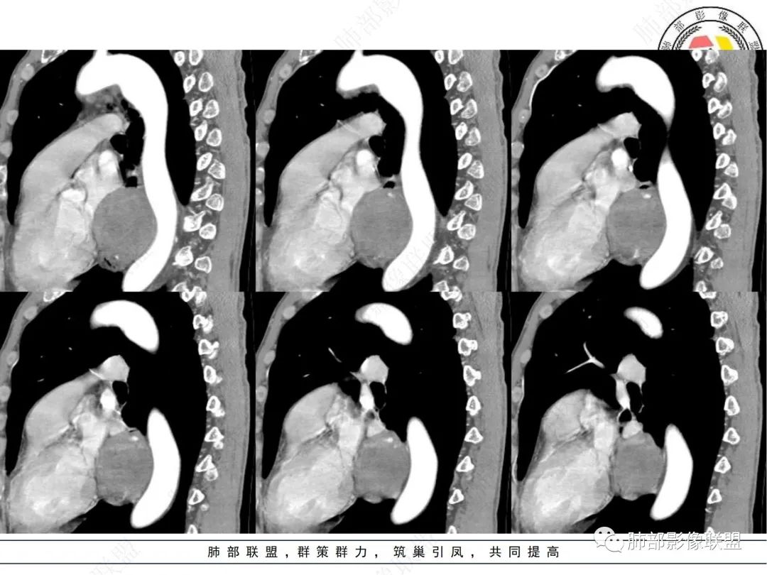 影像PPT - 【病例】后纵隔囊实性占位-11 影像PPT - 【病例】后纵隔囊实性占位-11