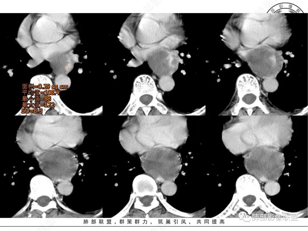影像PPT - 【病例】后纵隔囊实性占位-7 影像PPT - 【病例】后纵隔囊实性占位-7