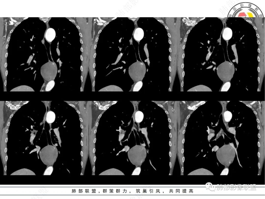 影像PPT - 【病例】后纵隔囊实性占位-12 影像PPT - 【病例】后纵隔囊实性占位-12