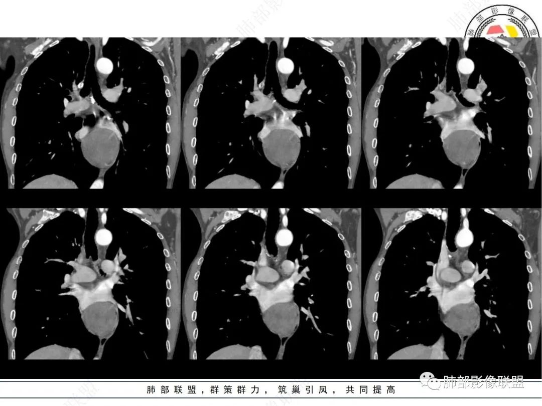 影像PPT - 【病例】后纵隔囊实性占位-13 影像PPT - 【病例】后纵隔囊实性占位-13